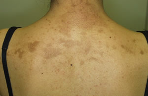 Post-inflammatory Hyperpigmentation[Case Photos]-Cosmetic Medicine in
