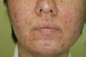Topical corticosteroids for acne